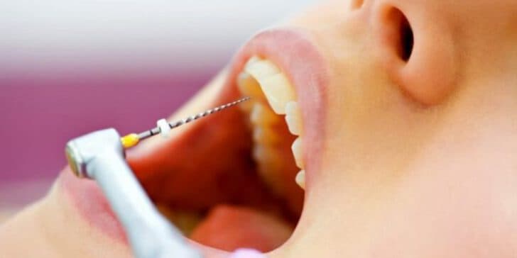 Endodoncia imagen