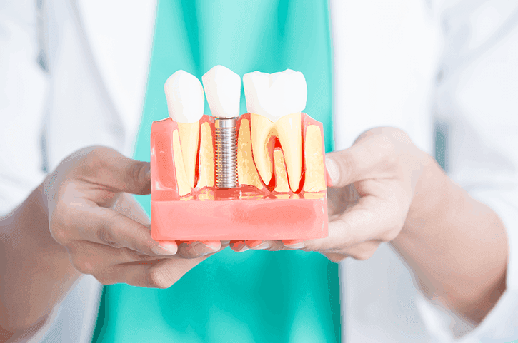 Implantes imagen